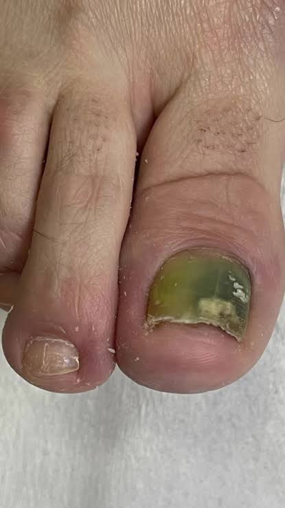 Unha do dedão com coloração esverdeada característica da síndrome do pé verde causada por Pseudomonas aeruginosa